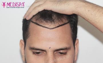 Dr. Suneet Soni - 2500 FUE Grafts, NW- III