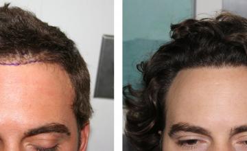 Dr. Bloxham: A Nice Little Hairline Repair | 3 Years Post Repair | Feller & Bloxham Medical, NY, NYC, LI