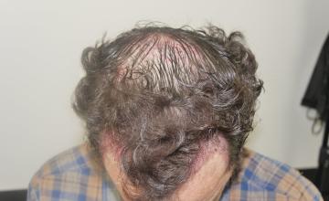 Dr. Glenn Charles 2401 grafts FUT Hairline and Crown