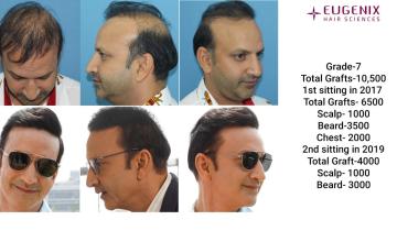 DISPLAYED ART OF 10,500 GRAFTS | NW7 | DR. SETHI | EUGENIX HAIR SCIENCES