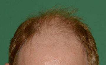 Raymond Konior, MD | Chicago Hair Institute | 3160 Graft Hair Restoration
