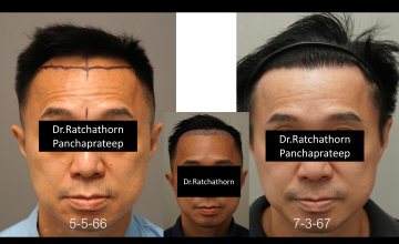 Dr.Ratchathorn Panchaprateep (Absolute hair clinic) Norwood 3: 10 months after 1910 grafts FUE wiith natural hairline