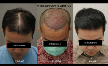 Dr.Ratchathorn Panchaprateep (Absolute hair clinic) 11 months after 3547 grafts FUE