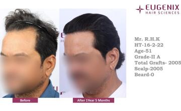 Eugenix Hair Sciences Clinic | Norwood Grade 2 A | 17 Months Hair Transplant Results | 2005 Grafts | Dr. Somesh