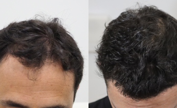 Dr. Espinosa Custodio - 2888 grafts - FUE Hair Transplant