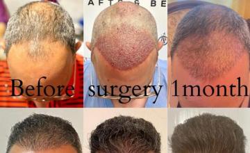 Bogota Hairlines 2951 Grafts 10 months