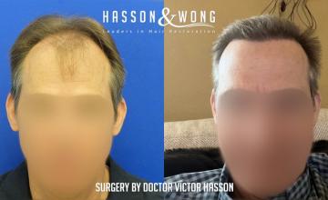 Hasson and Wong / Dr. Hasson / 5,000 grafts / FUE / frontal zone/ some temples and mid-scalp / only 5 months post-op