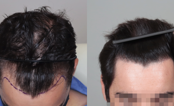 Dr. Espinosa Custodio (Spain and Mexico) - 3,115 grafts - FUE Hair Transplant