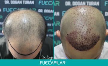 Dr. Turan - FUECAPILAR Clinic, Diffuse thinning NW VI progression, 3965 grafts