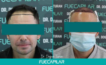 Dr. Turan - FUECAPILAR Clinic, Norwood IIIv, 2636 grafts