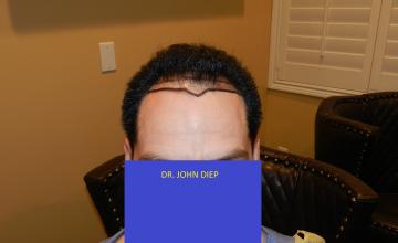 Dr. Diep 3,201 hair grafts transplant Norwood 4
