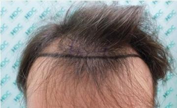 Dr. Christina at HDC clinic in Cyprus, 2500 FUE grafts for 24 years old patient