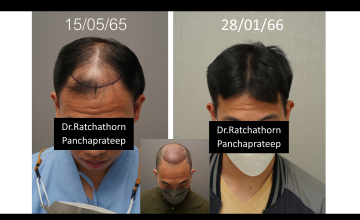 Dr.Ratchathorn Panchaprateep, MD, PhD (Absolute hair clinic): Norwood 5, 8 months after 36250 grafts FUE (life changing look)