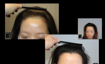 PANINE, MD | Chicago Hair Transplant Clinic | Hairline Augmentation | Woman | FUE Hair Transplant w/ 1,549 Grafts