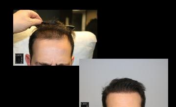 PANINE, MD | Chicago Hair Transplant Clinic | 2,684 Graft FUE Hair Transplant After 9 Months