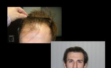 PANINE, MD | Chicago Hair Transplant Clinic | FUE Hair Transplant with 2,747 Grafts