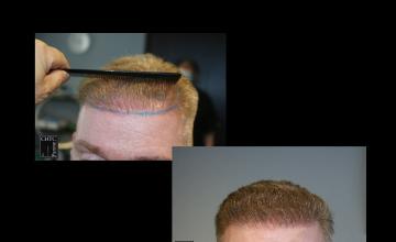PANINE, MD | Chicago Hair Transplant Clinic | 2,500 Graft FUE Hair Transplant Results at 7 Months Post-Op