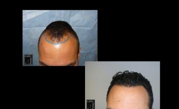 CHICAGO HAIR TRANSPLANT CLINIC | PANINE, MD | 2 FUE Procedures with 2,210 Grafts and 1,500 Grafts