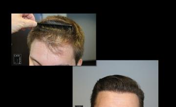 PANINE, MD | CHICAGO HAIR TRANSPLANT CLINIC | 2,500 Graft FUE Hair Transplant at 1 Year Post-Op