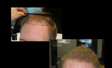PANINE, MD | Chicago Hair Transplant Clinic | FUE Hair Transplant with 2,874 Grafts | 1 Year Post-Op