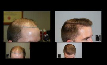 PANINE, MD | Chicago Hair Transplant Clinic | FUE Hair Transplant Results with 2,603 Grafts | 7 Months Post-Op