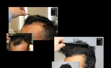 PANINE, MD | Chicago Hair Transplant Clinic | FUE Hair Transplant with 2,631 Grafts After One Year