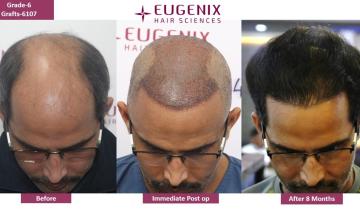 EUGENIX HAIR SCIENCES | NW6 | 8 MONTHS RESULT |