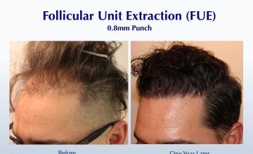 #BAM Natural-Appearing FUE Hairline Wavy Hair (3072 grafts): Carlos K. Wesley, M.D. (NYC & LA)