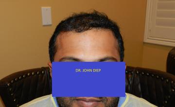 Advance Hair Loss Restored by Dr. Diep 4,817 hair grafts transplant