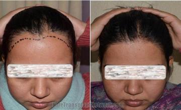 Female hair transplantation surgery before and after photos