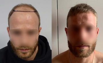 Frontal area before and after surgery