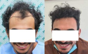 Before and after hair transplant, 3070 FUE grafts