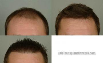 Before and after hair transplant procedure images