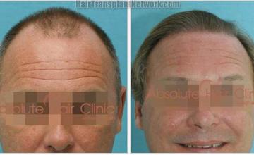 Before and after hair transplantation surgery