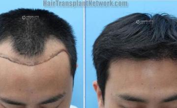 Front view - Before and after eyebrow transplant surgery