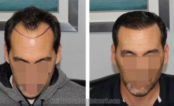 Hair restoration procedure before and after results