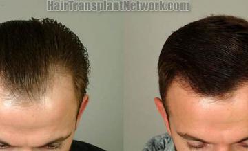 Front view - Before and after