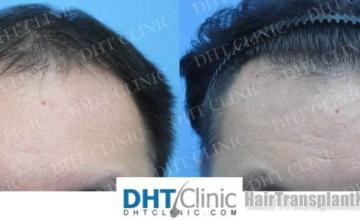 Front view - Before and after hair restoration procedure