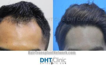 Before and after hair restoration procedure
