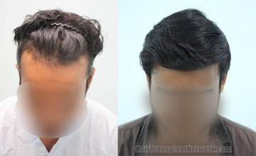 Hair restoration procedure before and after results