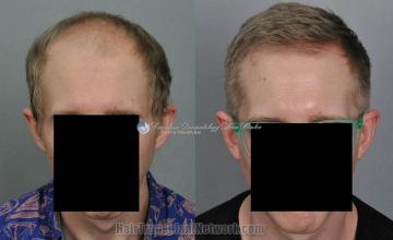 Front view - Before and after hair restoration procedure