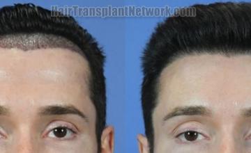 Front view - Before and after