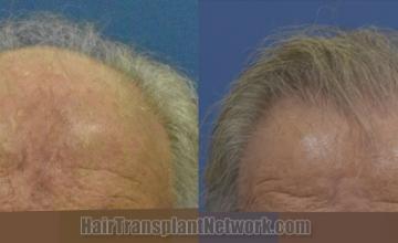 Front view - Before and after