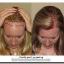 Hairline  Lowering Procedures for Women with a High Forehead