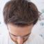 Men's Hair loss Treatments and Solutions